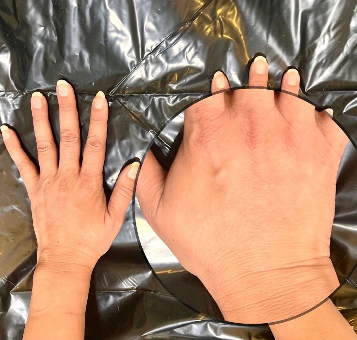 Hand rejuvenation result